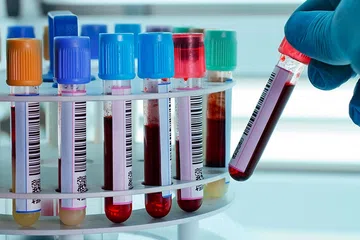 Estudo da Einstein identifica disparada das hepatites virais no Brasil