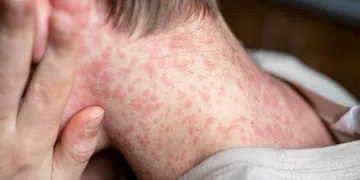 Sarampo: Brasil em Alerta de Reintrodução, entenda riscos, sintomas e vacinação